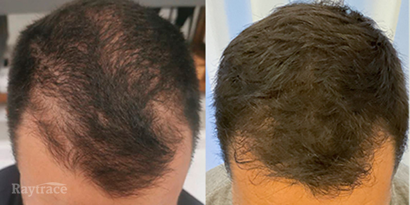 Antes e depois de tratamento para queda de cabelo com o Raytrace