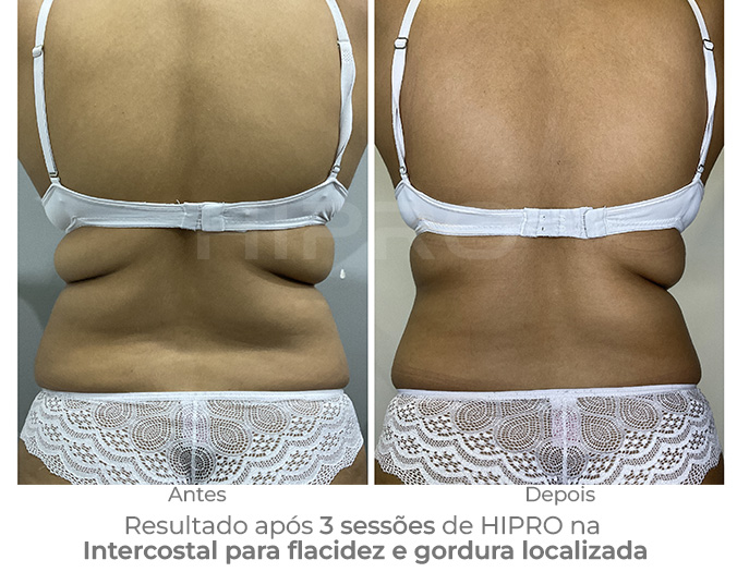 antes e depois de 3 sessoes de hipro para gordura localizada