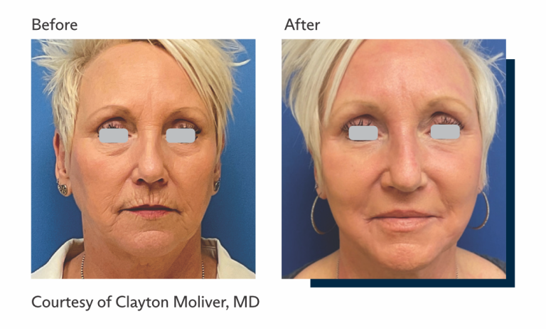 Antes e depois tratamento Ultrapulse Alpha Brasil-1