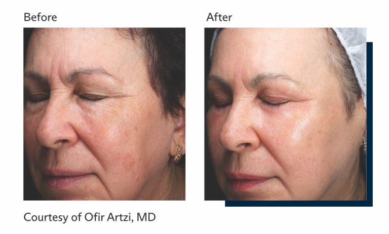 Antes e depois tratamento Ultrapulse Alpha Brasil-2