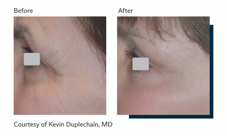 Antes e depois tratamento Ultrapulse Alpha Brasil-3