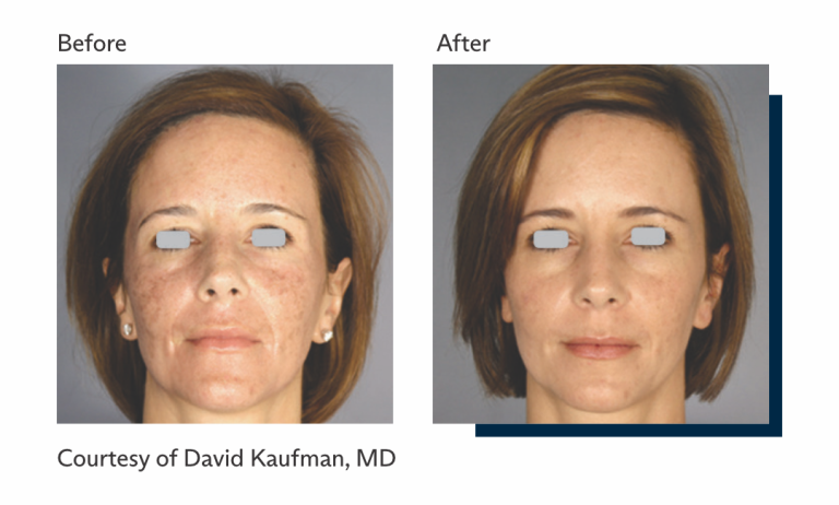 Antes e depois tratamento Ultrapulse Alpha Brasil-4