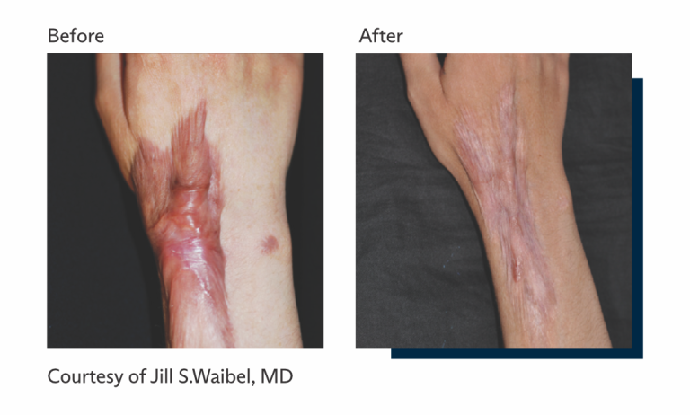 Antes e depois tratamento Ultrapulse Alpha Brasil-5