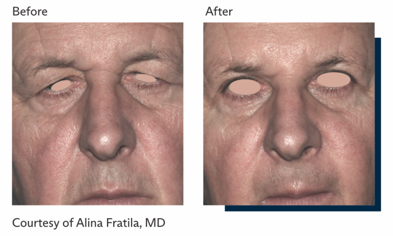 Antes e depois tratamento Ultrapulse Alpha Brasil-7