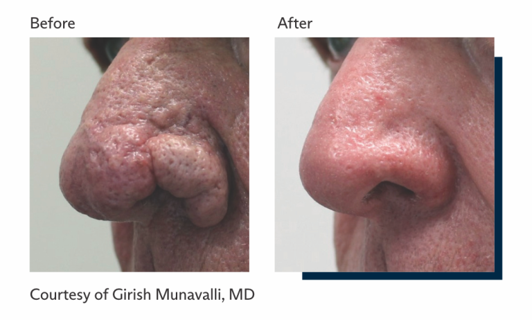 Antes e depois tratamento Ultrapulse Alpha Brasil-8