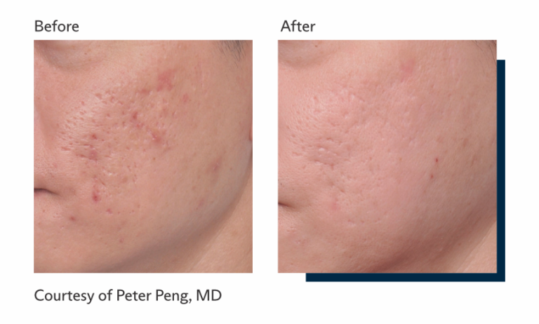 Antes e depois tratamento Ultrapulse Alpha Brasil-9