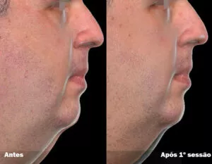 RESULTADO DE 1 SESSÃO