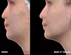 RESULTADO DE 1 SESSÃO