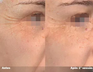 RESULTADO DE 1 SESSÃO