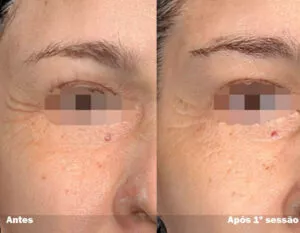 RESULTADO DE 1 SESSÃO