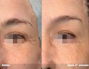 RESULTADO DE 1 SESSÃO