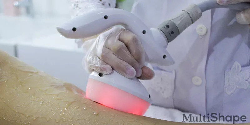 Aplicadora realizando o MultiShape, que é um tratamento estético não invasivo