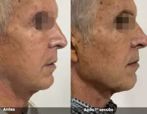 RESULTADO DE 1 SESSÃO