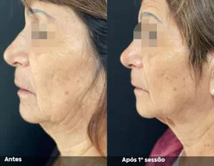 RESULTADO DE 1 SESSÃO