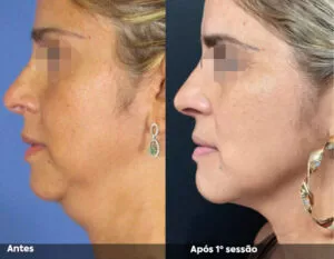 RESULTADO DE 1 SESSÃO