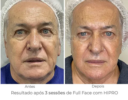 Tratamento full face para rejuvenescimento facial com o hipro