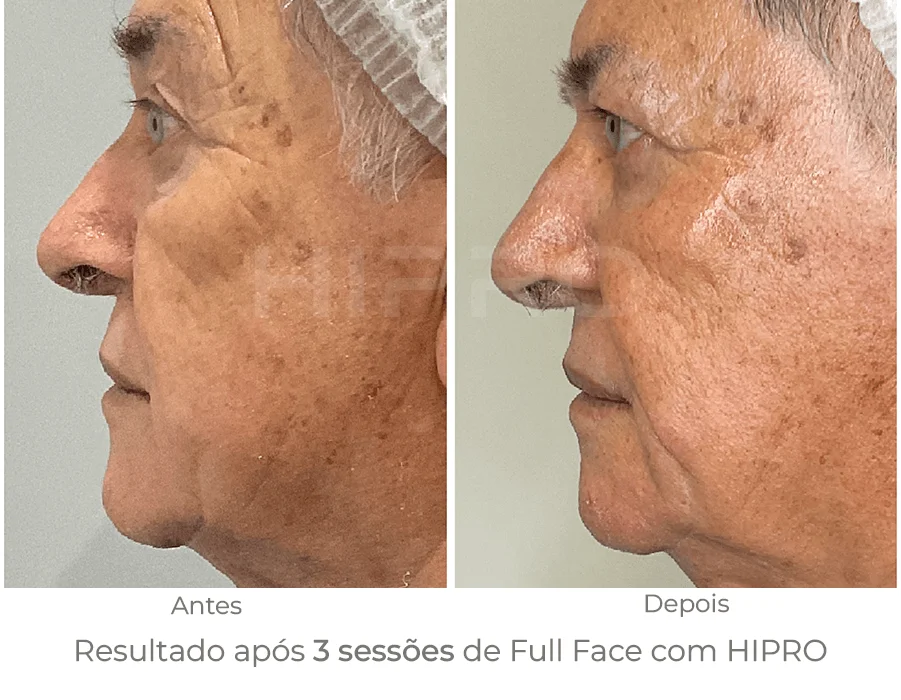 Rejuvenescimento facial com ultrassom microfocado HIPRO full face