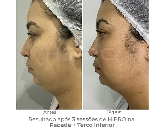 Tratamento para redução de papada e terço inferior com o hipro