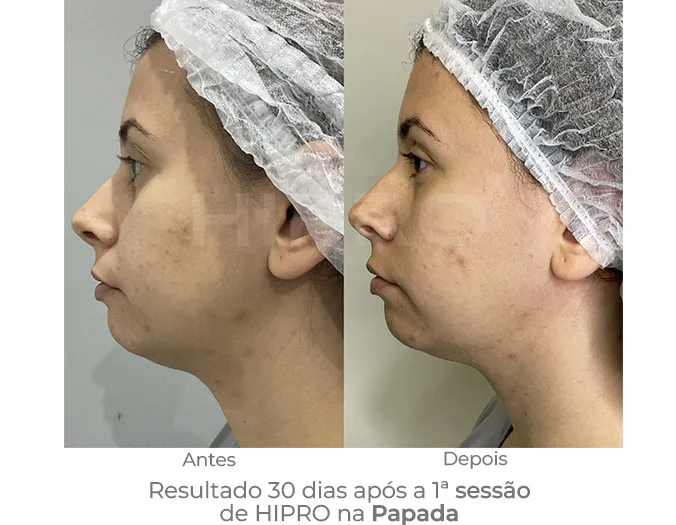 reducao de papada sem cirurgia com o hipro ultrassom microfocado