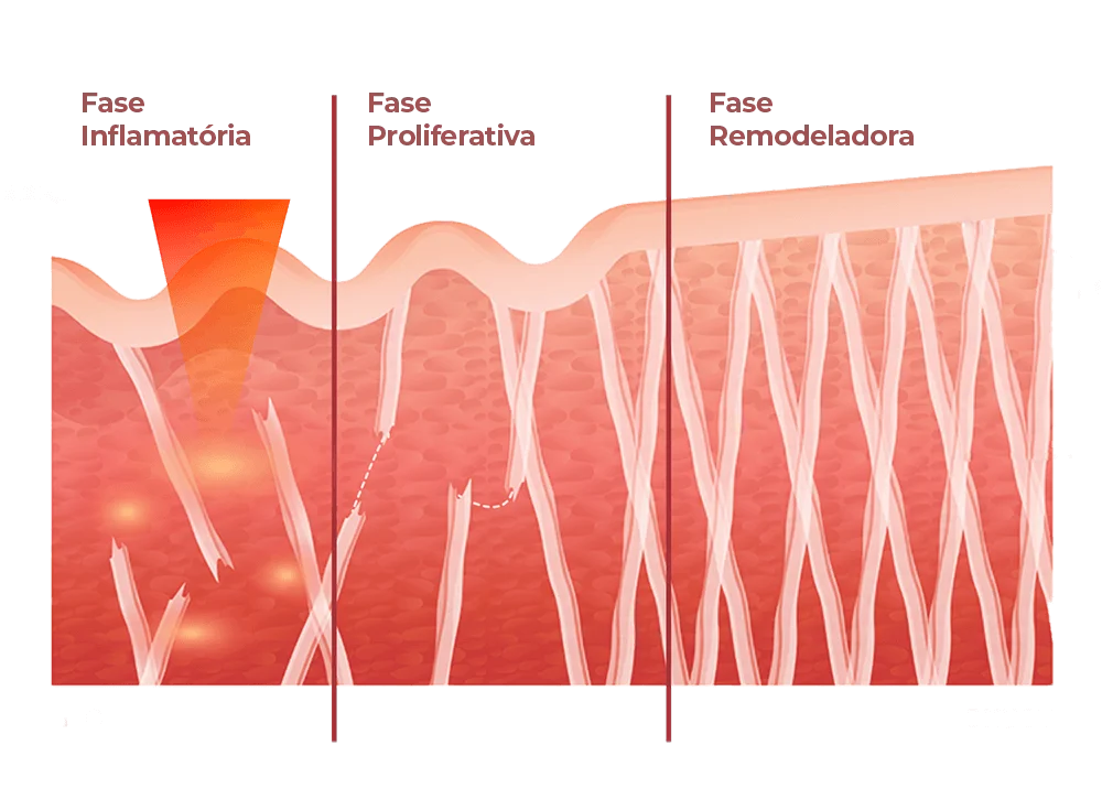Processo-da-pele-com-hifu