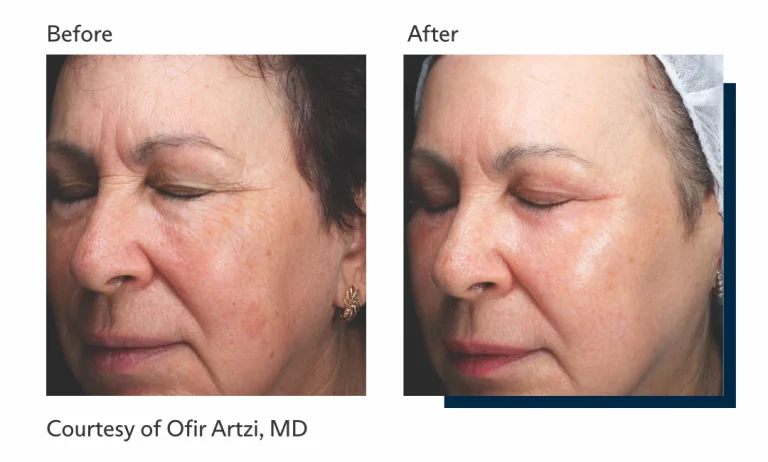 Antes e depois tratamento Ultrapulse Alpha Brasil-2