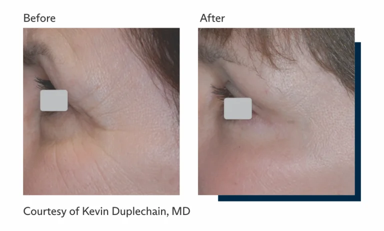 Antes e depois tratamento Ultrapulse Alpha Brasil-3