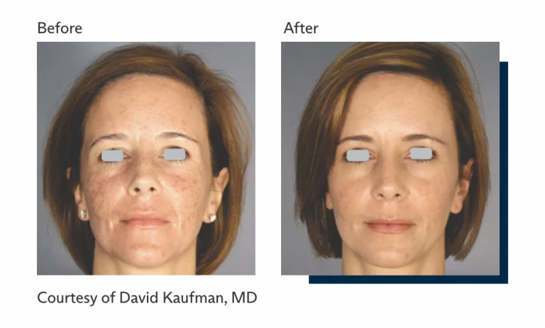 Antes e depois tratamento Ultrapulse Alpha Brasil-4