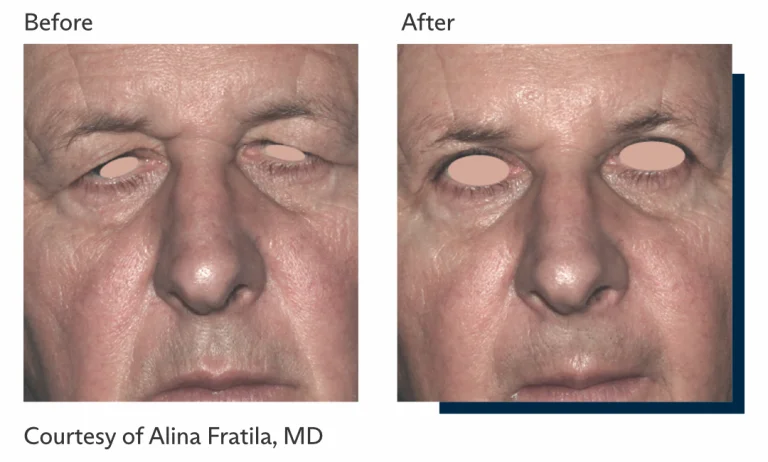 Antes e depois tratamento Ultrapulse Alpha Brasil-7